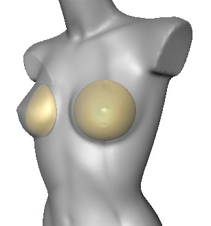 Example of 3D simulation for breast augmentation planning