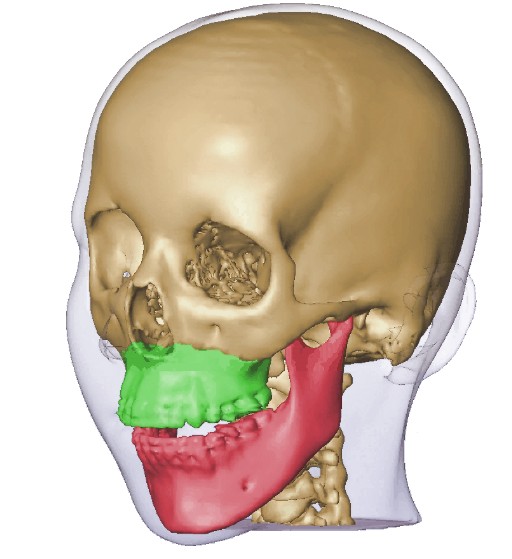 Example of cranio-maxillofacial 3D surgical planning