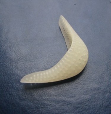 Example of patient-specific implant modeling
