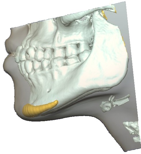 3D visualization used for custom implant design